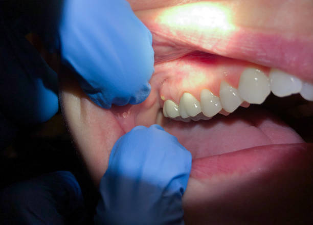 Best Emergency Dental Care for Sports Injuries in White Hall, IL